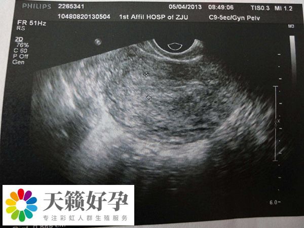 女性做人工授精失敗轉試管注意事項