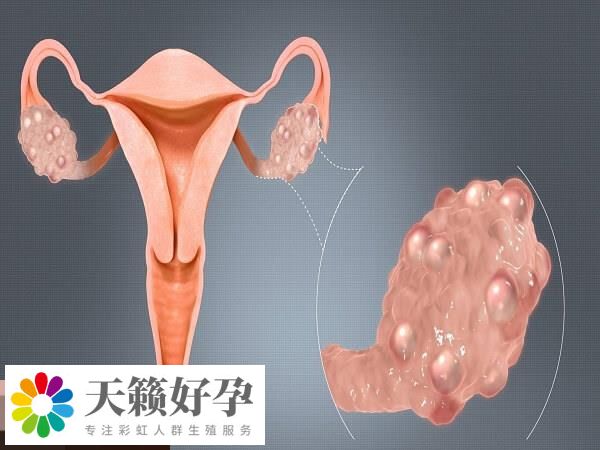 輸卵管存在炎癥大部分會有積水
