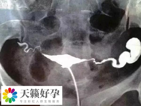 做試管嬰兒輸卵管積水有影響！易增加宮外孕風險要知曉