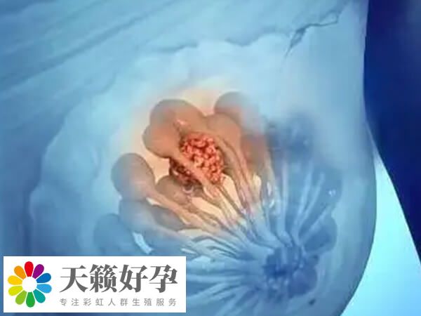 乳腺纖維瘤做試管會不會影響加重